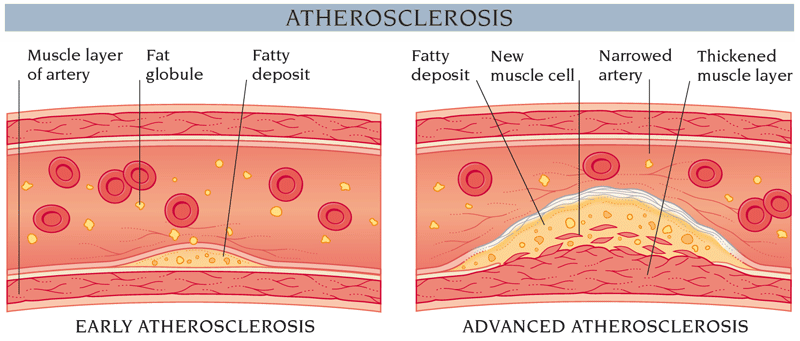 What is the hardening of the arteries, and what are the symptoms?